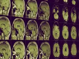 alzheimer lityum