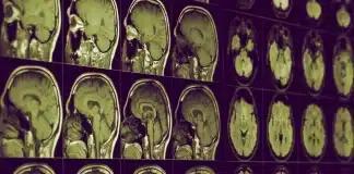 alzheimer lityum