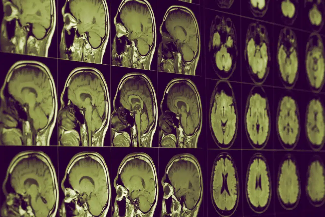 alzheimer lityum