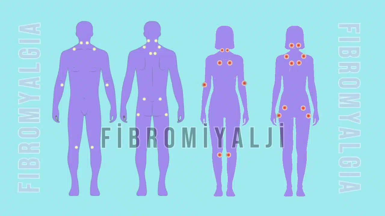 Fibromiyaljiye ne iyi gelir