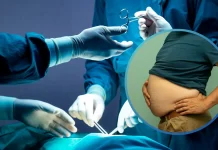 Obezite cerrahisi sonrası vücut kitle indeksi değişimi, tüp mide ameliyatı ve tip 2 diyabet üzerindeki olumlu etkileri.