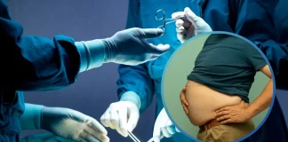 Obezite cerrahisi sonrası vücut kitle indeksi değişimi, tüp mide ameliyatı ve tip 2 diyabet üzerindeki olumlu etkileri.