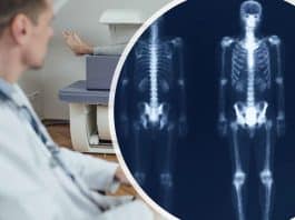 Osteoporoz teşhisinde DEXA testi: Kemik erimesi ölçümü ve T-skoru