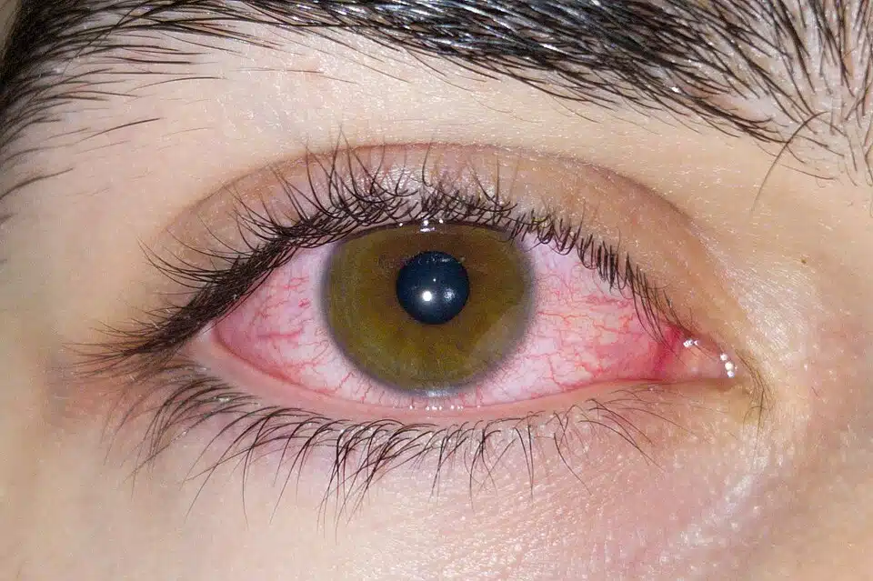 Op. Dr. Sezer Hacıağaoğlu'nun göz ovuşturma, viral konjonktivit ve lens kullanımı hakkındaki uyarıları ve önerileri.