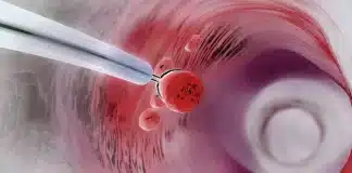 Kolon polipleri ve kanser riski: Erken tanı için kolonoskopi, korunma için lifli beslenme ve sağlıklı bağırsak florası.