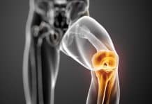 Robotik diz cerrahisi: Total diz protezi, diz protezi ömrü ve ameliyat sonrası iyileşme süreci üzerine bir konsept.