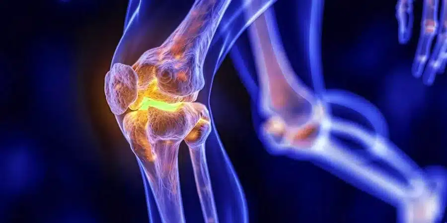 Kireçlenme (Osteoartrit) nedir? Eklem kireçlenmesi belirtileri ve protez cerrahisi hakkında uzman görüşleri.