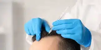 Kök Hücre Destekli Saç Ekimi: Farkı, Avantajları ve Sonuçları Kök hücre saç ekimi: Avantajları, saç köklerinin tutunma oranı ve saç ekimi sonrası iyileşme süreci.