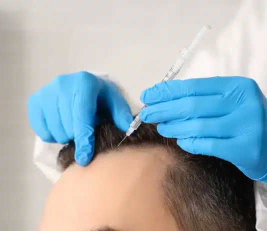 Kök hücre saç ekimi: Avantajları, saç köklerinin tutunma oranı ve saç ekimi sonrası iyileşme süreci.