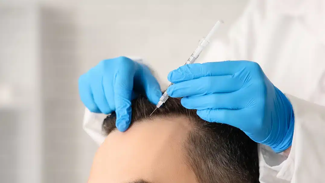 Kök hücre saç ekimi: Avantajları, saç köklerinin tutunma oranı ve saç ekimi sonrası iyileşme süreci.