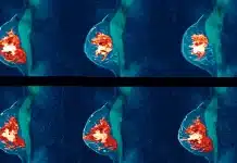 Meme kanserinden korunmak mümkün mü? Risk faktörleri ve erken tanı Meme kanserinden korunmak mümkün mü? Risk faktörleri, erken tanı yöntemleri ve kendi kendine meme muayenesi adımları.