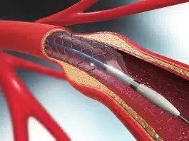 Akut stent trombozu riski: Stent tıkanıklığı belirtileri, kalp krizi ve çift kan sulandırıcı tedavi (DAPT) konsepti.