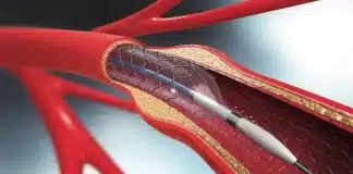 Akut stent trombozu riski: Stent tıkanıklığı belirtileri, kalp krizi ve çift kan sulandırıcı tedavi (DAPT) konsepti.