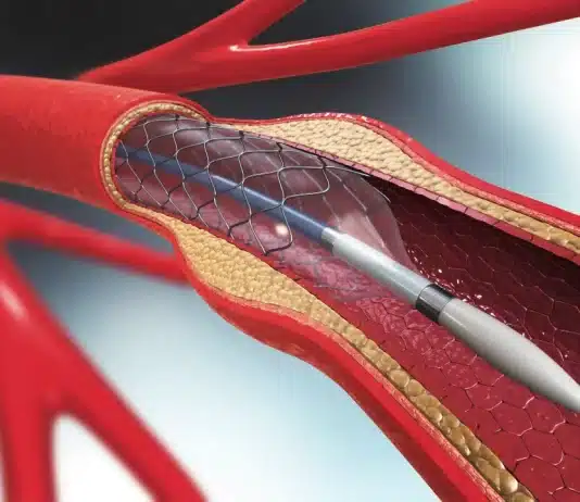 Akut stent trombozu riski: Stent tıkanıklığı belirtileri, kalp krizi ve çift kan sulandırıcı tedavi (DAPT) konsepti.