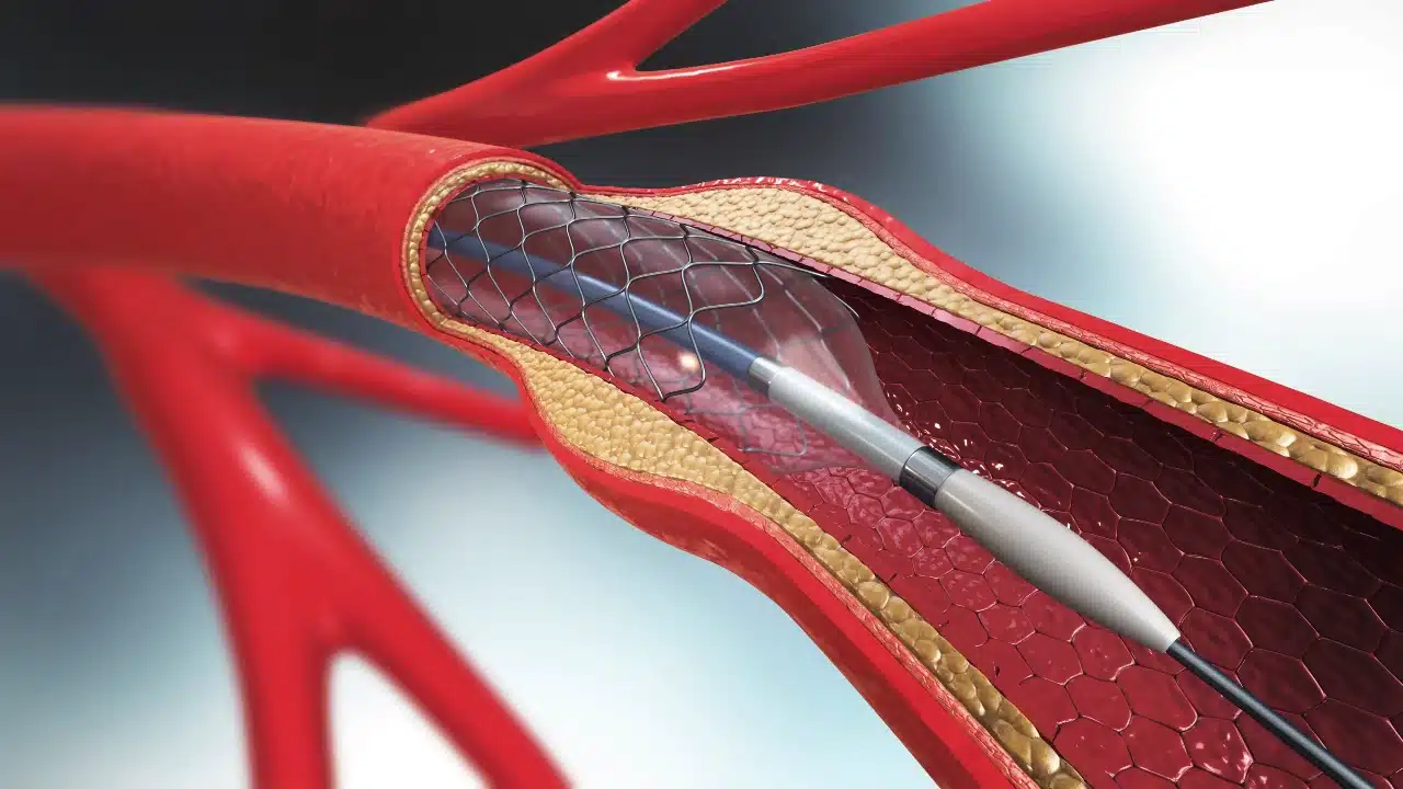 Akut stent trombozu riski: Stent tıkanıklığı belirtileri, kalp krizi ve çift kan sulandırıcı tedavi (DAPT) konsepti.