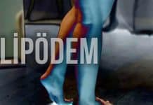 Lipödem belirtileri ve kalın bacak sorunu Çizme fermuarı kapanmayanlar için lipödem uyarısı: Prof. Dr. Ahmet Karacalar'dan kalın bacak sorunu ve tedavi yöntemleri.