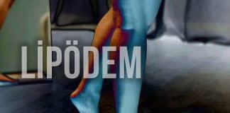 Lipödem belirtileri ve kalın bacak sorunu Çizme fermuarı kapanmayanlar için lipödem uyarısı: Prof. Dr. Ahmet Karacalar'dan kalın bacak sorunu ve tedavi yöntemleri.