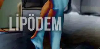 Lipödem belirtileri ve kalın bacak sorunu Çizme fermuarı kapanmayanlar için lipödem uyarısı: Prof. Dr. Ahmet Karacalar'dan kalın bacak sorunu ve tedavi yöntemleri.