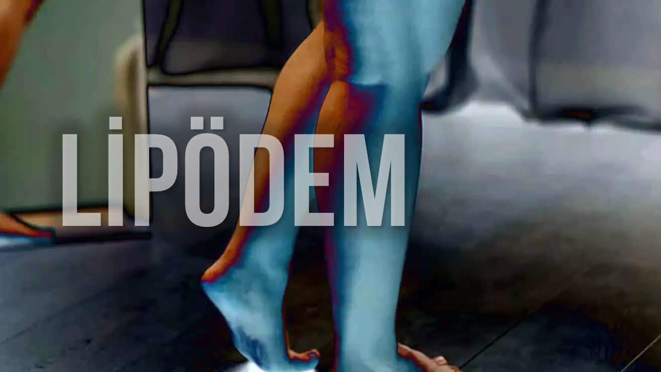 Çizme fermuarı kapanmayanlar için lipödem uyarısı: Prof. Dr. Ahmet Karacalar'dan kalın bacak sorunu ve tedavi yöntemleri.