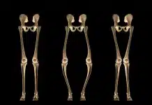 Raşitizm Hakkında Bilinmesi Gerekenler Raşitizm nedir ve belirtileri nelerdir: Çocuklarda sağlıklı kemik gelişimi ve D vitamini önemi.