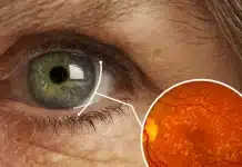 Sarı nokta hastalığı tedavisi seçenekleri: Göz içi mercek implantı, teleskopik lens teknolojisi ve görme kaybı hakkında uzman bilgileri.