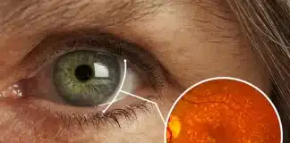 Sarı nokta hastalığı tedavisi seçenekleri: Göz içi mercek implantı, teleskopik lens teknolojisi ve görme kaybı hakkında uzman bilgileri.