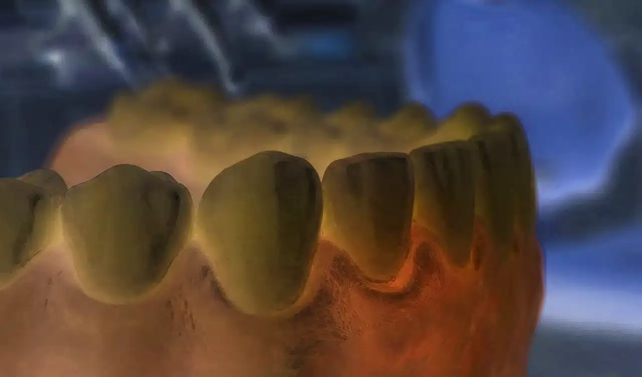 Diş eti yanması ve ağrısı yaşayan bir hastanın diş hekimi muayenesi görseli.