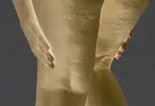 Lipödem hastalığına bağlı alt beden orantısızlığı ve ağrılı yağlanma sendromunu gösteren anatomik çizim