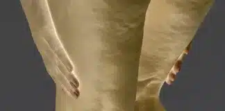 Lipödem hastalığına bağlı alt beden orantısızlığı ve ağrılı yağlanma sendromunu gösteren anatomik çizim