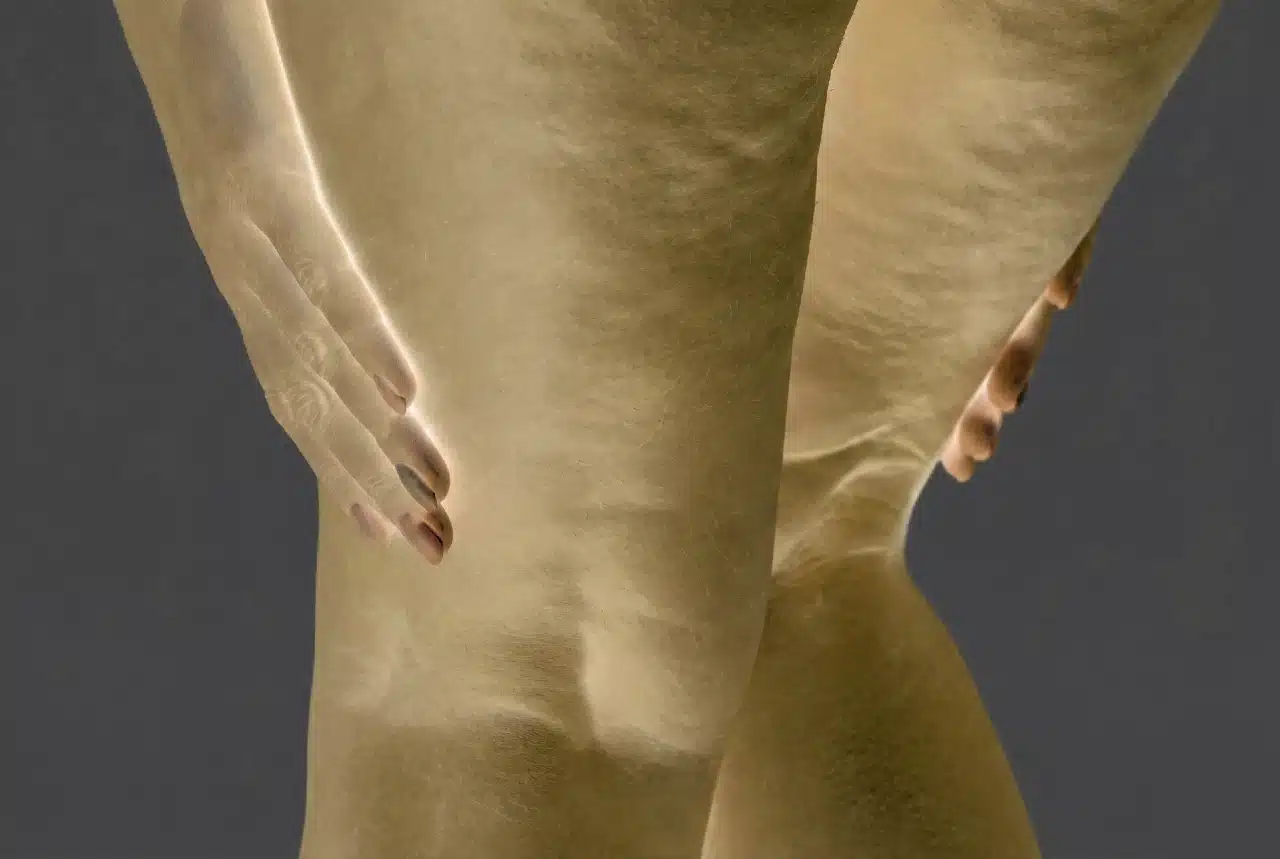 Lipödem hastalığına bağlı alt beden orantısızlığı ve ağrılı yağlanma sendromunu gösteren anatomik çizim