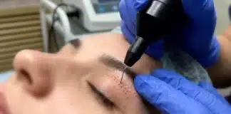 Uzman doktor tarafından uygulanan ameliyatsız göz kapağı estetiği işlemi. Plexr lazer tedavisi