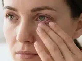 Demodex paraziti kaynaklı kirpik dibi iltihabı ve kepeklenme belirtileri