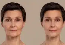 Zayıflama iğnesi yüzü nasıl etkiler? Yan etki: Ozempic face