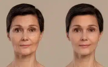 Zayıflama iğnesi yüzü nasıl etkiler? Yan etki: Ozempic face