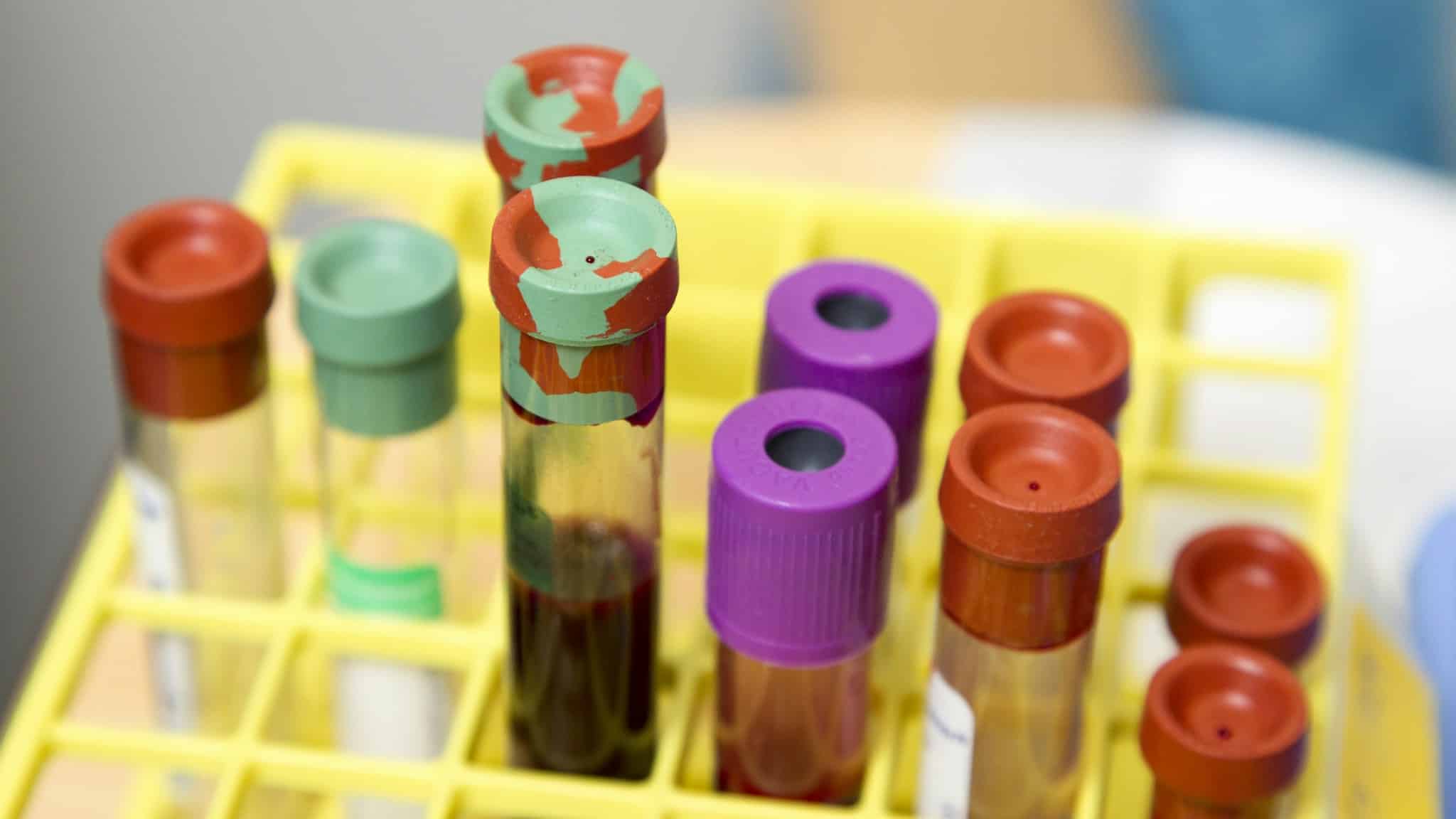 Laboratuvarda test tüpleri, ücretsiz ve anonim HIV testi