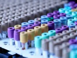 Cinsel yolla bulaşan hastalıklar: Sessiz enfeksiyonlara dikkat Laboratuvarda kan tüpleri, cinsel yolla bulaşan hastalıklar için test ve tarama