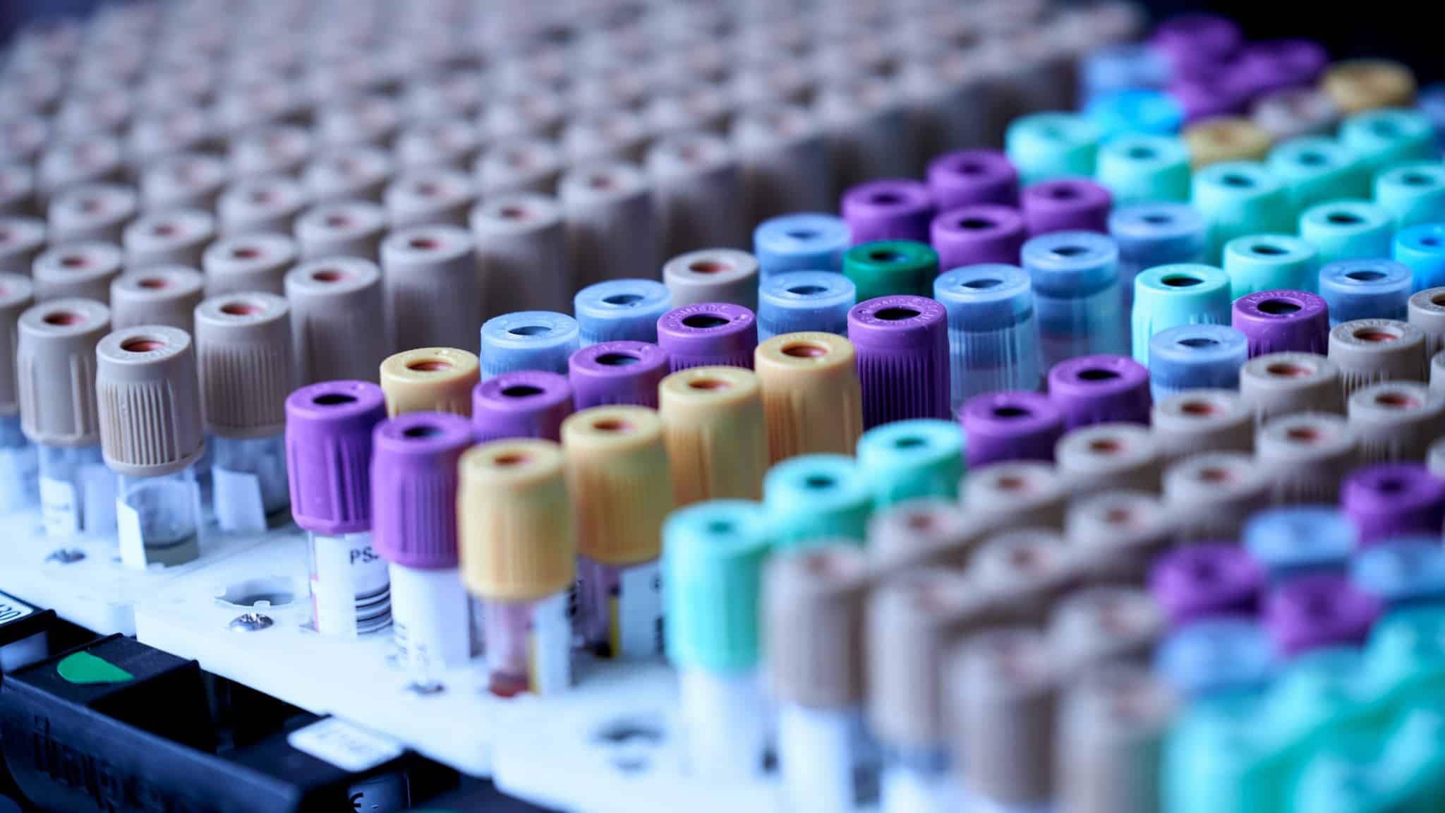 Laboratuvarda kan tüpleri, cinsel yolla bulaşan hastalıklar için test ve tarama