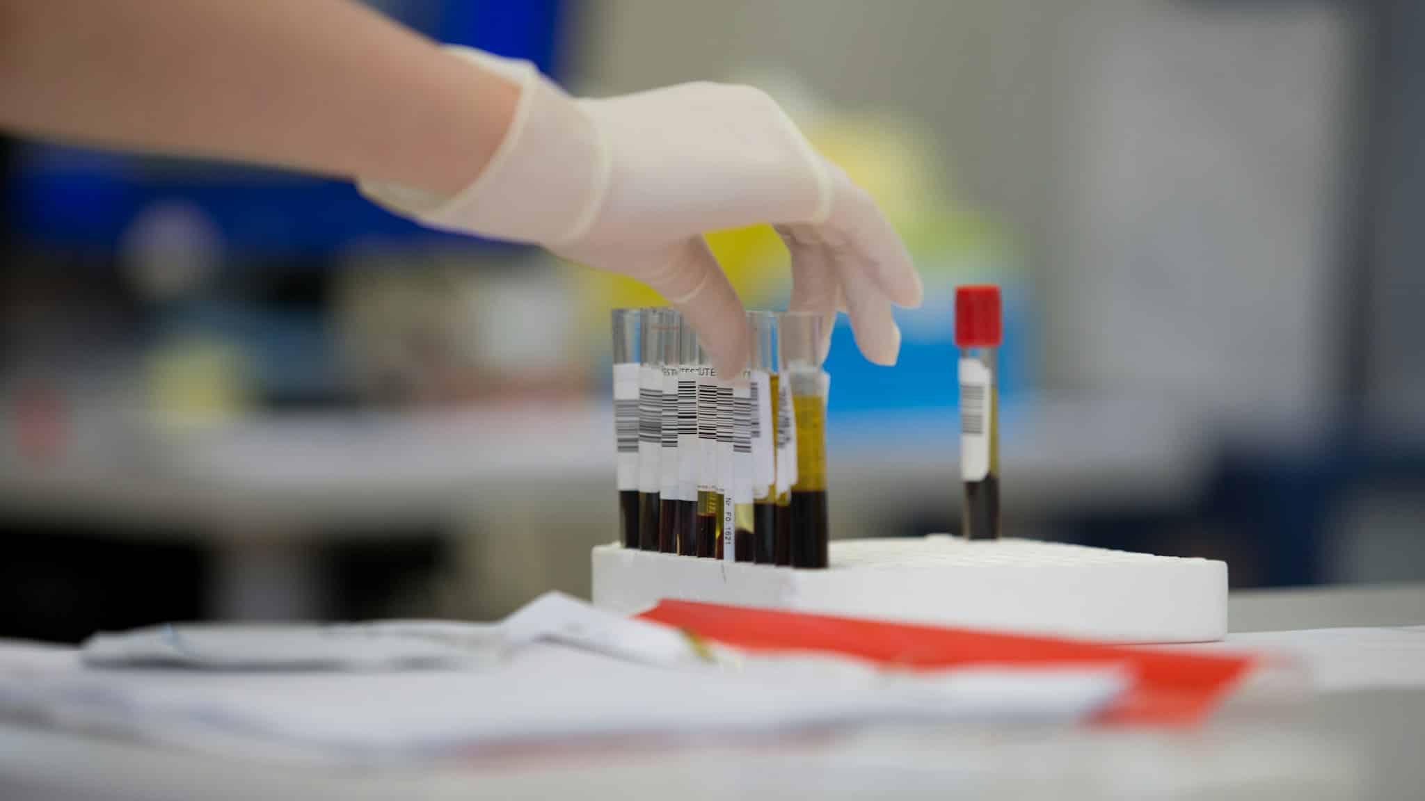 Hepatit taraması için alınan kan örneğini tutan eldivenli bir el