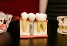 İmplant tedavisi sürecini gösteren diş implantı modeli