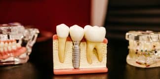 İmplant tedavisi sürecini gösteren diş implantı modeli