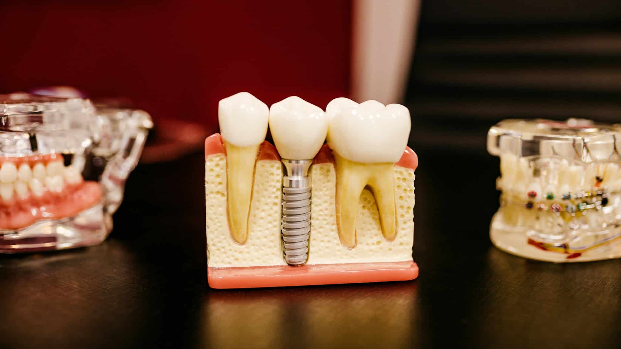 İmplant tedavisi sürecini gösteren diş implantı modeli