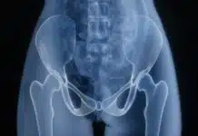 Osteoporoz: Güçlü kemikler için 5 önemli öneri Osteoporoz açısından kırık riski taşıyan kalça ve leğen kemiğinin röntgen görüntüsü