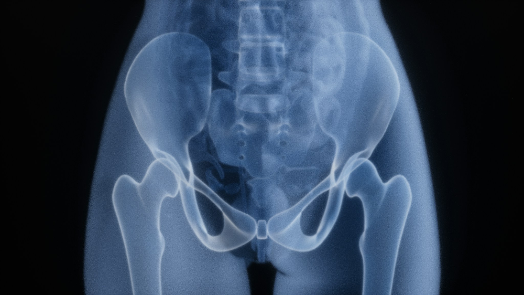 Osteoporoz açısından kırık riski taşıyan kalça ve leğen kemiğinin röntgen görüntüsü