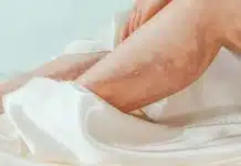 Varis sadece estetik bir sorun değil: Bacaklardaki mor çizgiler neden kaynaklanır? Varis nedeniyle bacaklarında belirgin mor damar çizgileri görülen kadın
