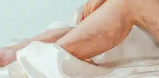 Varis nedeniyle bacaklarında belirgin mor damar çizgileri görülen kadın
